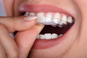 Salt Lake City ClearCorrect clearcorrect alignersⓡ 3rd south dental dentist in salt lake city ut